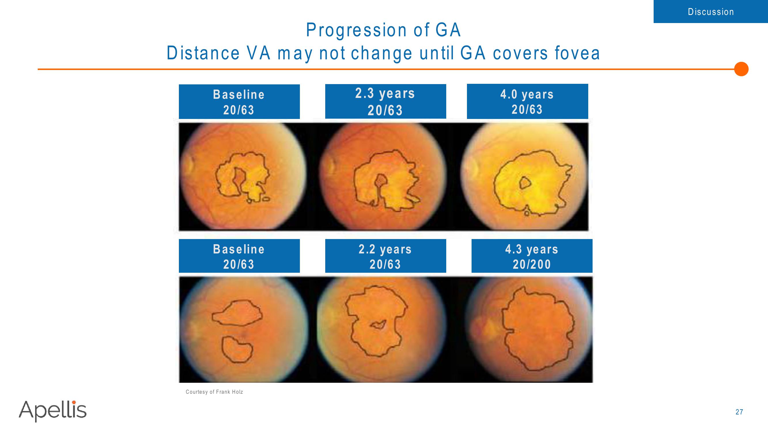 Apellis R&D Day 2018 slide image #27