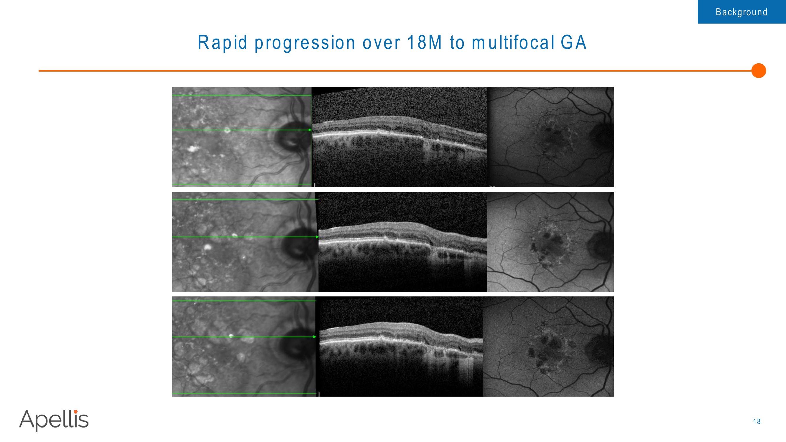 Apellis R&D Day 2018 slide image #18